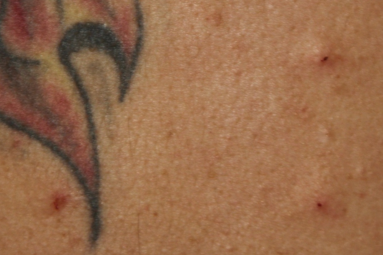 Neuraltherapie Detail